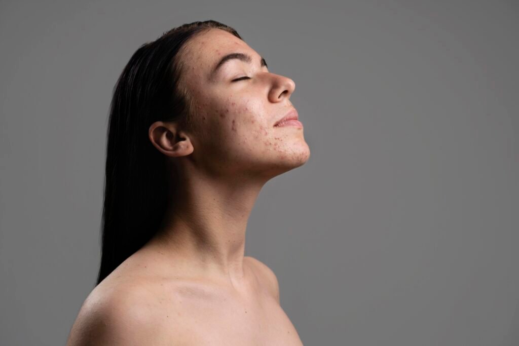 Clear Skin Starts Here 5 Best Acne Care Products That Actually Work